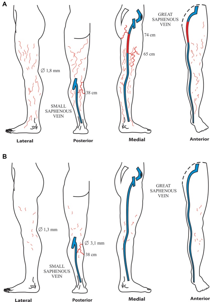 Desenho do mapa de ultrassom das pernas de uma paciente, antes (A) e depois (B) do tratamento, com as safenas em azul e as veias doentes em vermelho